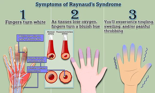 Experts Hail Potential Cure for Raynaud's Disease, Affecting Up to 30 Million Americans