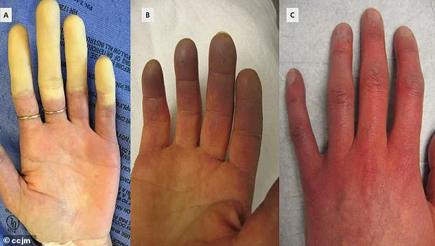 Experts Hail Potential Cure for Raynaud's Disease, Affecting Up to 30 Million Americans