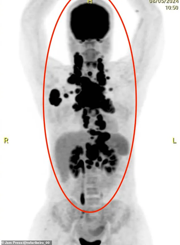 Exclusive: Privileged Access Sheds Light on Superbug's Lifesaving Role in Cancer Battle
