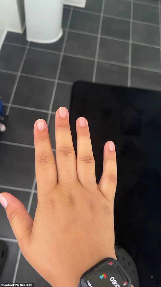 The Long Road to Diagnosis: Challenges in Identifying Rare Autoimmune Diseases