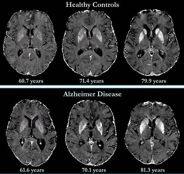 Breakthrough Study by Johns Hopkins University Reveals New Method for Predicting Dementia Using Quantitative Susceptibility Mapping (QSM)