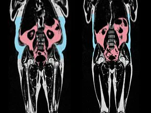Danish Study Reveals Underweight May Pose Greater Mortality Risk Than Overweight or Mild Obesity