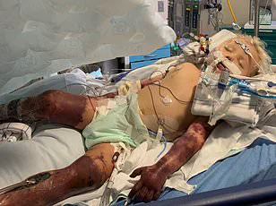 Exclusive Access to Groundbreaking Study Reveals Type 2 Diabetes Linked to Elevated Sepsis Risk