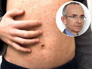 Measles Linked to Fatal Neurological Complication in LA Child, Warns Health Officials