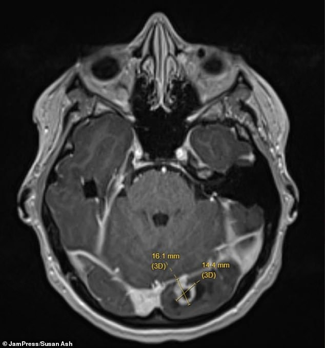 New Mother's Seizure Reveals Deadly Brain Tumor