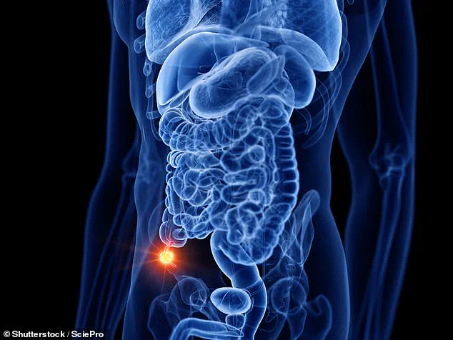Sharp Rise in Appendix Cancer Among Those Under 50, Study Finds – Incidence Triples Since 1940s