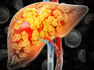Silent Health Crisis: 80 to 100 Million U.S. Adults May Live with Undiagnosed Fatty Liver Disease