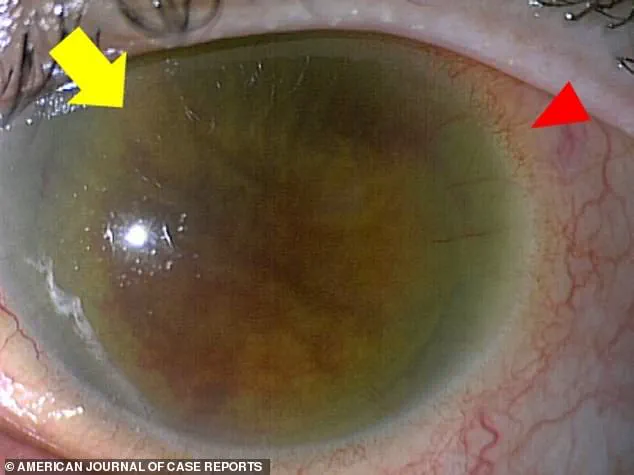 Deadly Threat of Normally Harmless Bacteria Sparks Rising Concerns Over Group G Streptococcus Infections