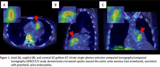 Deadly Threat of Normally Harmless Bacteria Sparks Rising Concerns Over Group G Streptococcus Infections