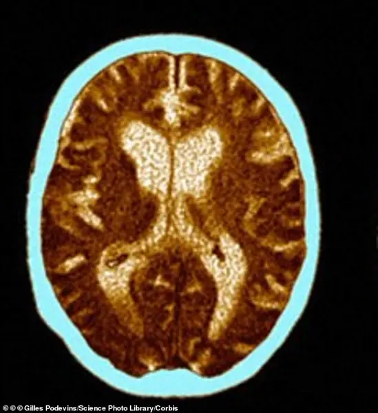 Visible Aging Signs Tied to 60% Higher Dementia Risk in 12-Year Study, Chinese Research Reveals