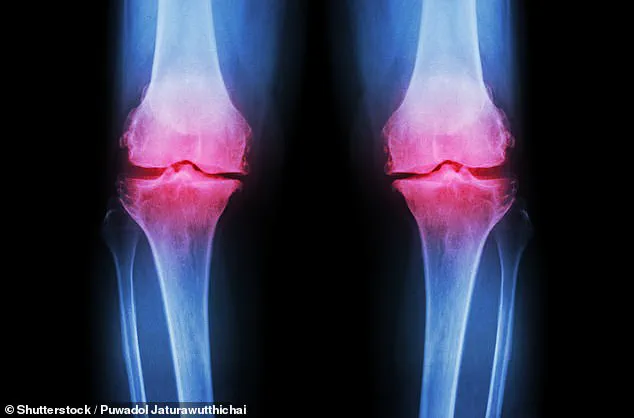 Osteoarthritis: A Growing Global Concern as Prevalence Rises to One Billion by 2050
