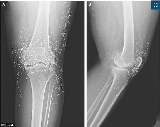 Urgent Alert: Alarming Discovery of Gold Threads from Acupuncture in South Korean Woman's Knee Sparks Safety Concerns