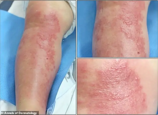 Urgent Alert: Alarming Discovery of Gold Threads from Acupuncture in South Korean Woman's Knee Sparks Safety Concerns