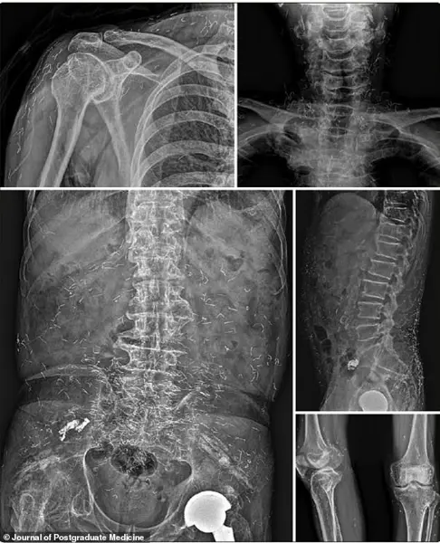 Urgent Alert: Alarming Discovery of Gold Threads from Acupuncture in South Korean Woman's Knee Sparks Safety Concerns