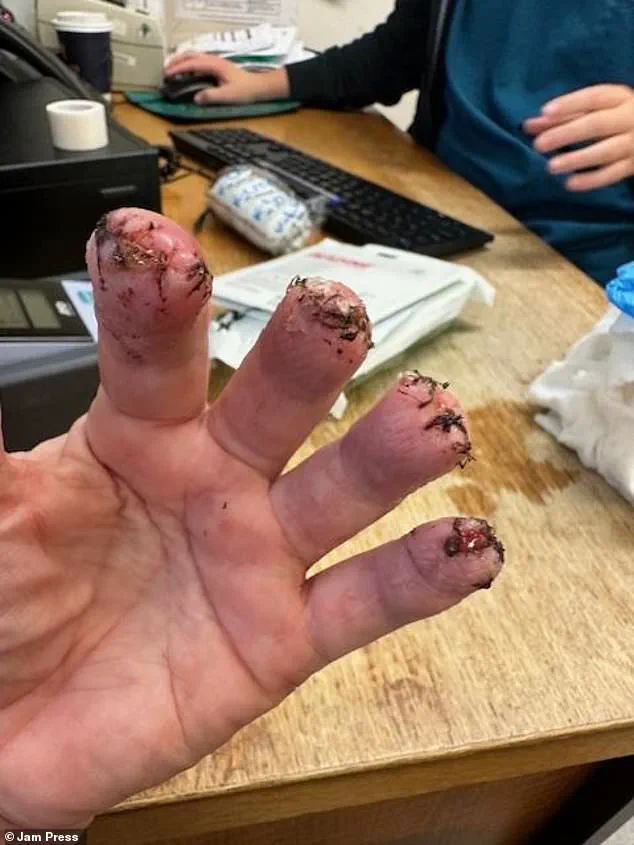 Controversy Over Delayed Medical Intervention for Swansea Woman with Recurring Kidney Stones