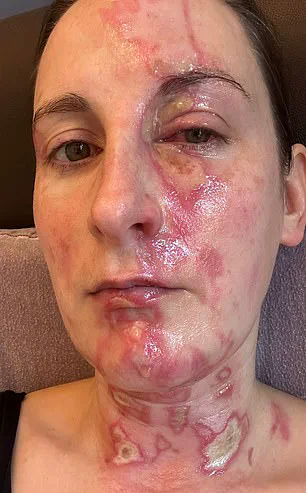 Blender Accident Leaves Home Cook with Severe Burns and Possible Scarring