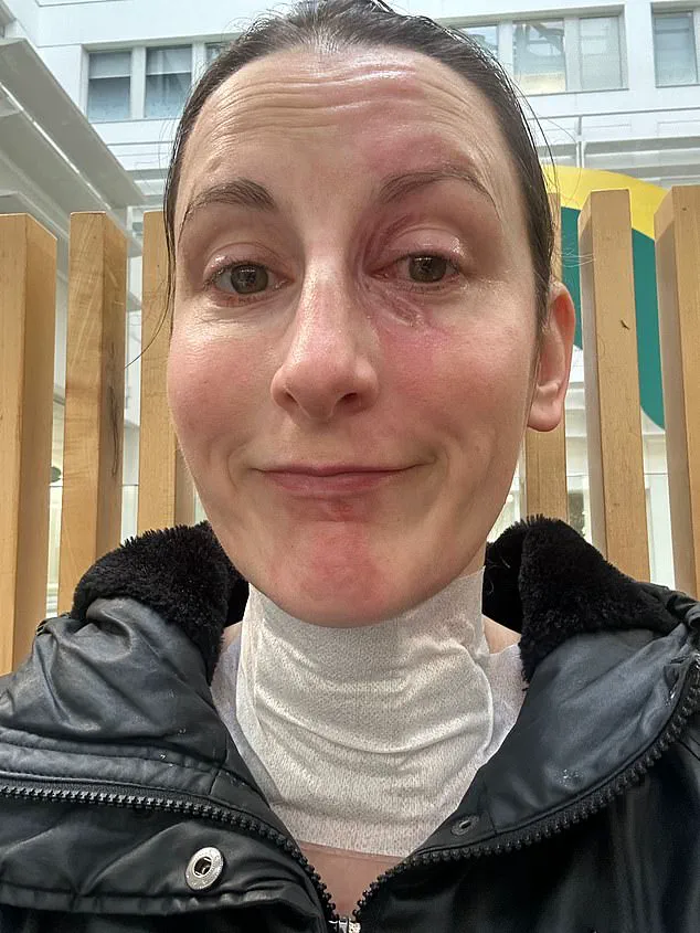 Blender Accident Leaves Home Cook with Severe Burns and Possible Scarring