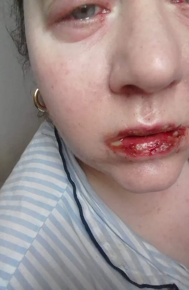 A Routine Choice with Unforeseen Consequences: Jo Daniels on Benylin's Life-Changing Impact