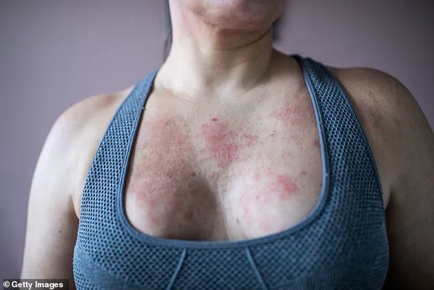 Eczema and Its Lifelong Impact: A Personal Story