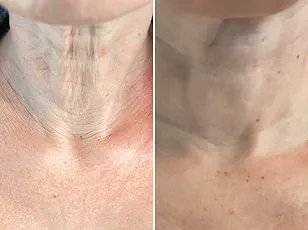 Experts Caution: Vitamin D's Role in Hair Loss Demands Urgent Public Awareness