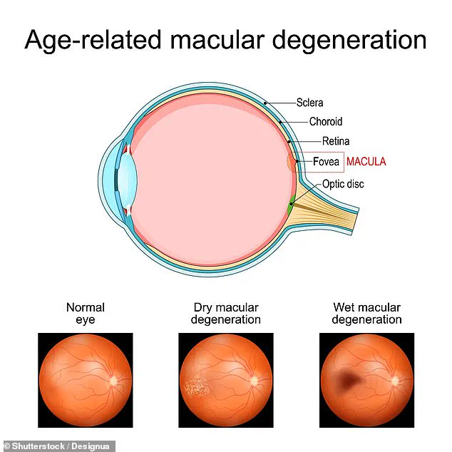 Metformin May Reduce Risk of Age-Related Macular Degeneration in Older Adults