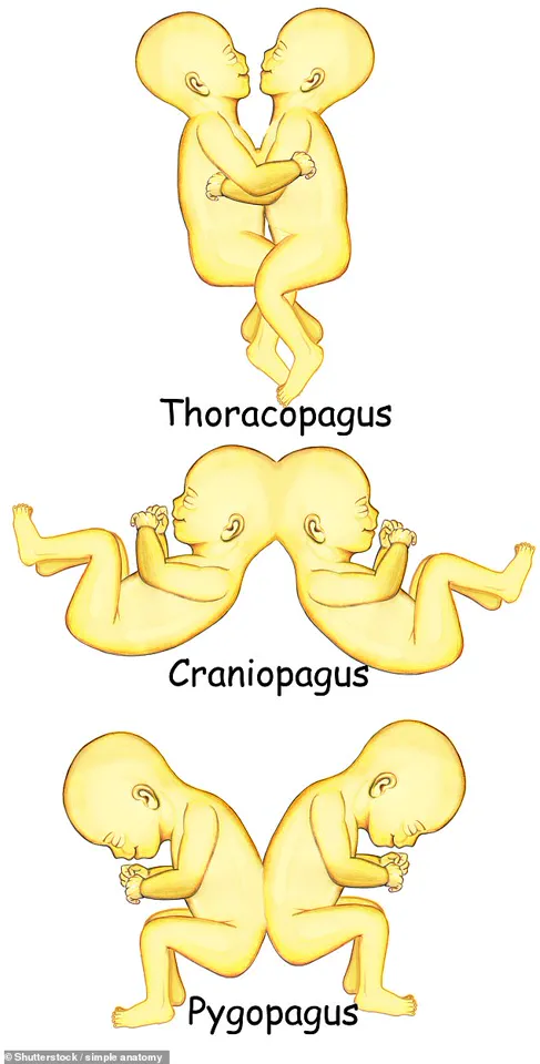 AI Conjoined Twins Captivate Social Media, Raising Questions About Real-Life Challenges