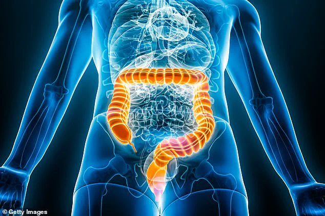 Bowel Cancer Surge Among Young People in Britain and Other Nations, But Not in Parts of Europe