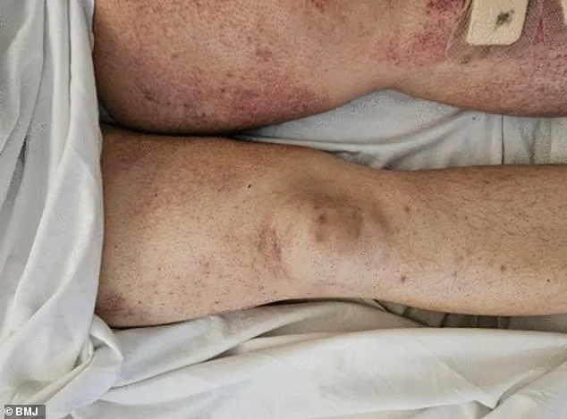 GLP-1 Weight Loss Injections Linked to Surge in Scurvy Cases Amid Poor Diet Habits