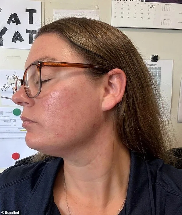 The Hidden Burden of Adult Acne: A Silent Struggle Affecting Millions and Shattering Self-Esteem