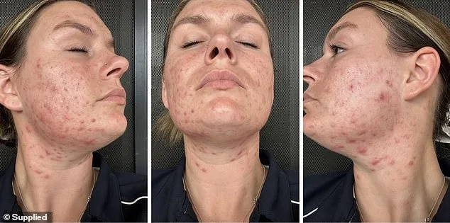The Hidden Burden of Adult Acne: A Silent Struggle Affecting Millions and Shattering Self-Esteem