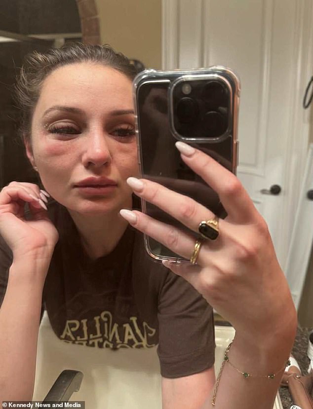 Mercedes Brooke's Health Crisis: From Hair Loss to Life-Threatening Symptoms