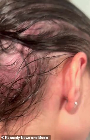 Mercedes Brooke's Health Crisis: From Hair Loss to Life-Threatening Symptoms