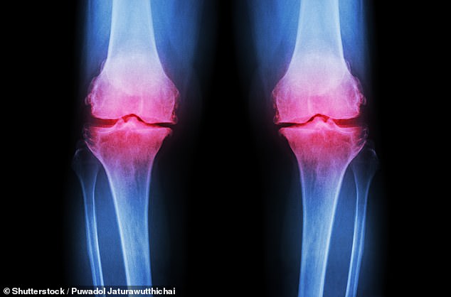 Younger People Face Surge in Bone Injuries and Early Osteoarthritis Linked to High-Intensity Fitness Trends, Warn Experts