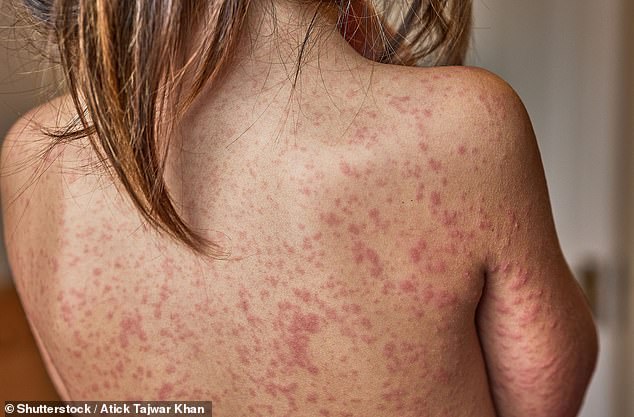 Measles Resurgence in London: Unvaccinated Children Fuel Growing Public Health Crisis