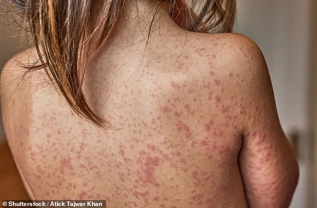 Measles Resurgence in London: Unvaccinated Children Fuel Growing Public Health Crisis