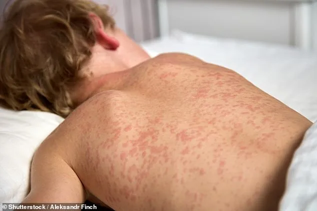Measles Exposure at Highland High: Unvaccinated Students Face 90% Infection Risk in Utah