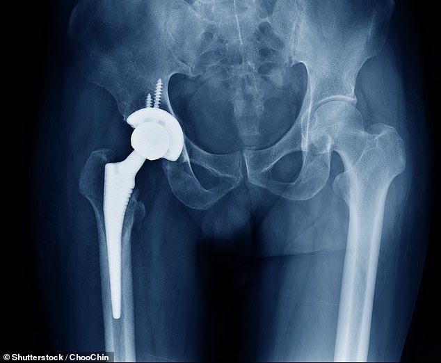 NHS Faces Crisis as Bone Cement Shortage Threatens Thousands of Joint Surgeries