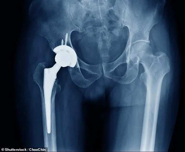NHS Faces Crisis as Bone Cement Shortage Threatens Thousands of Joint Surgeries