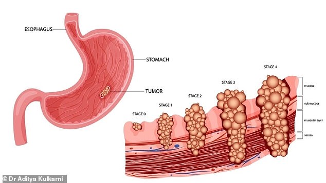 Silent Killer Resurges as Stomach Cancer Spreads to Younger Patients, Fueling a Hidden Epidemic
