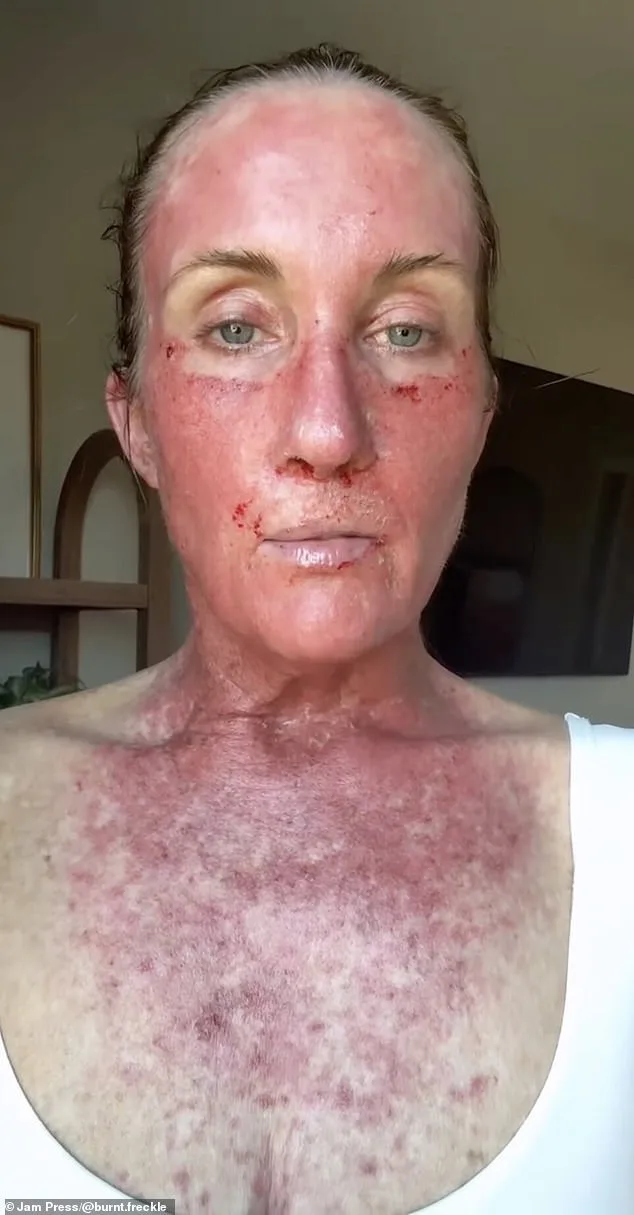 Kory Feltz's 20-Year Battle with Recurrent Skin Cancer