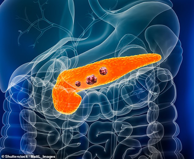 New Hope in Pancreatic Cancer Fight: Early Warning Signal from Pre-Cancerous Cell Clusters Identified