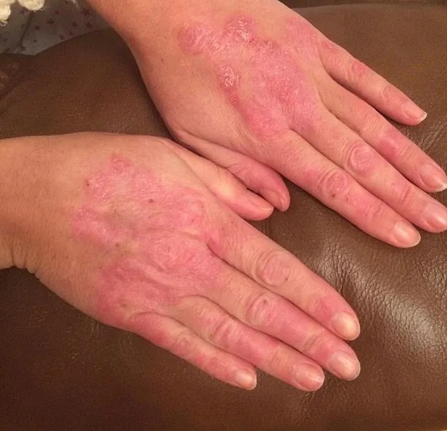 20 Years of Struggle: Janine Price's Relentless Battle with Psoriasis and Psoriatic Arthritis