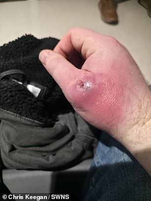 Coventry Man's Severe Infection After Spider Bite Highlights Spread of False Widow Spiders