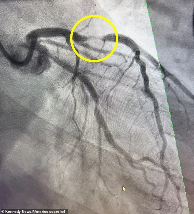 Young Fitness Buff Dismisses Heart Attack Symptoms as Spicy Food Effect, Survives Near-Fatal Crisis