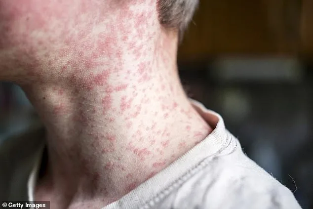 Measles Resurgence in US: SSPE and Unvaccinated Children Fuel Outbreak Concerns