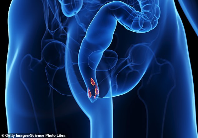 How a Simple Daily Habit and Lifestyle Change Helped Me Overcome Hemorrhoids