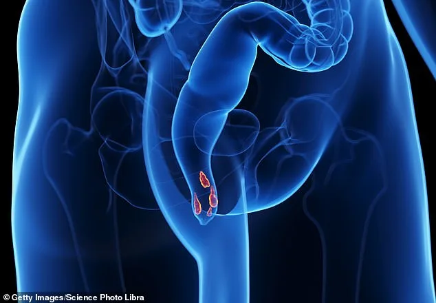 How a Simple Daily Habit and Lifestyle Change Helped Me Overcome Hemorrhoids