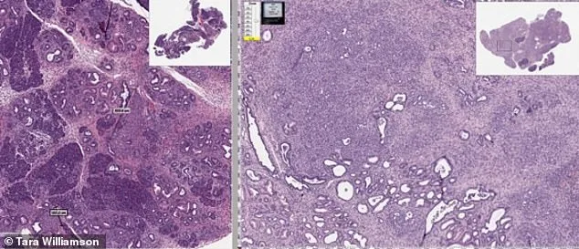 Long-Buried Cold War Secret and a Forgotten Drug: Mebendazole's Surprising Cancer Cure Potential