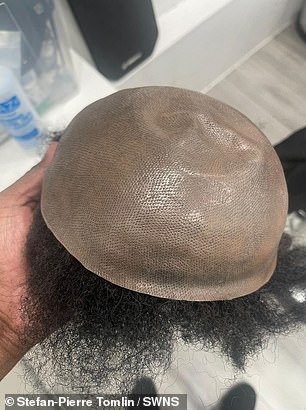 From Lies to Liberation: A Model's Decade-Long Battle with Baldness and a £5,000 Hair Transplant