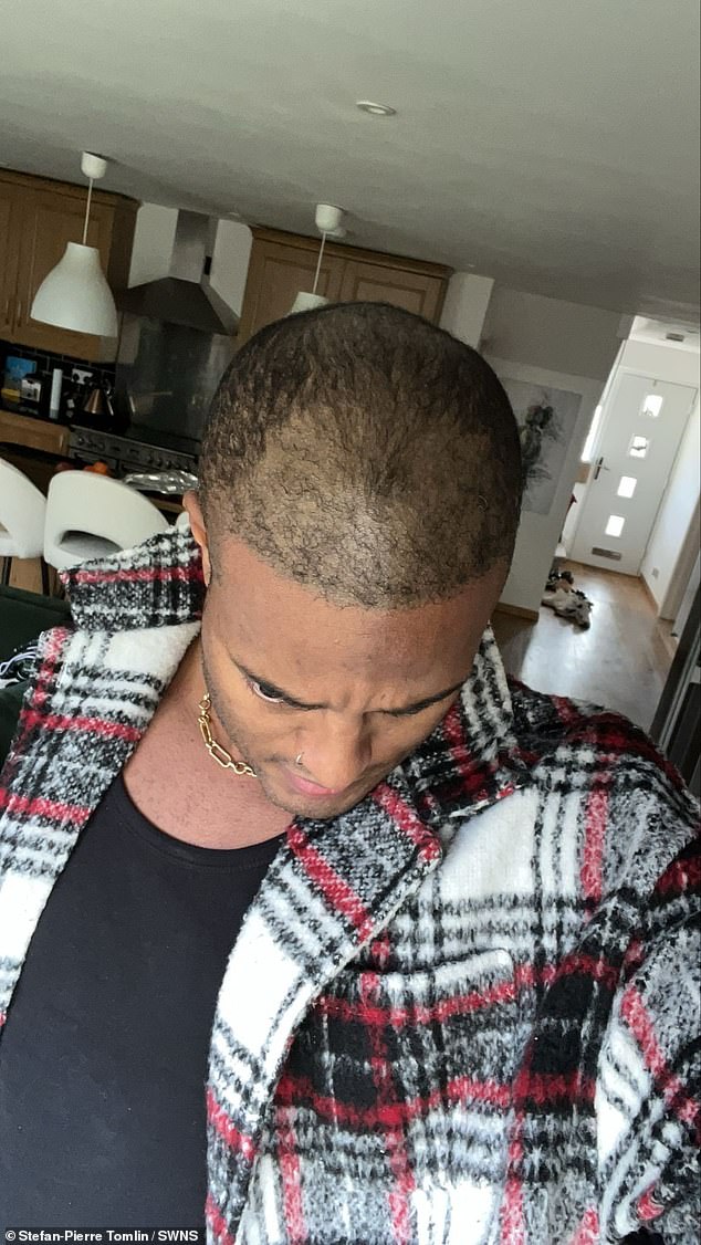 From Lies to Liberation: A Model's Decade-Long Battle with Baldness and a £5,000 Hair Transplant